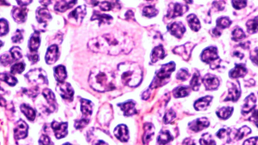 El extraño caso de la curación de un linfoma de Hodgkin por el COVID-19