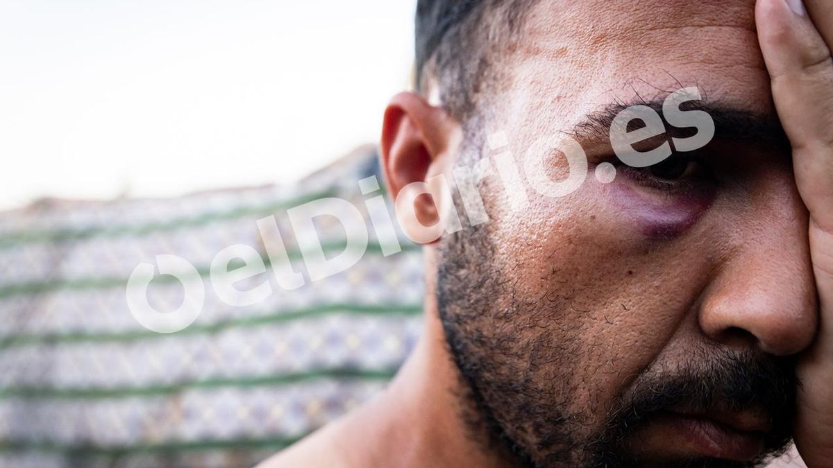 Un hombre con el ojo hinchado que denuncia haber sido agredido por militares.