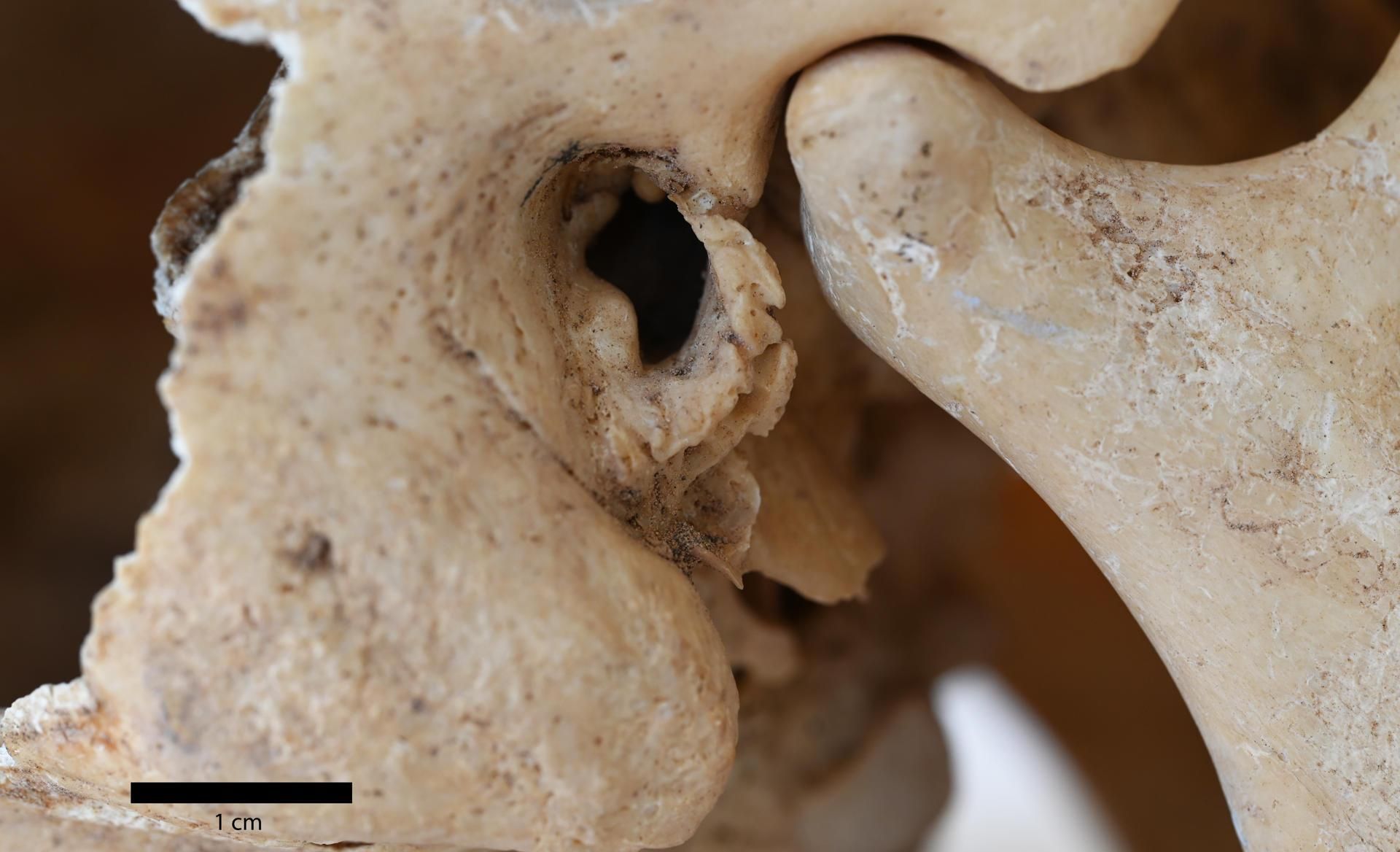Cráneo de un hombre de 18 a 25 años recuperado del yacimiento de El Agujero, en Gáldar, en la costa norte de Gran Canaria, con crecimiento óseo.
