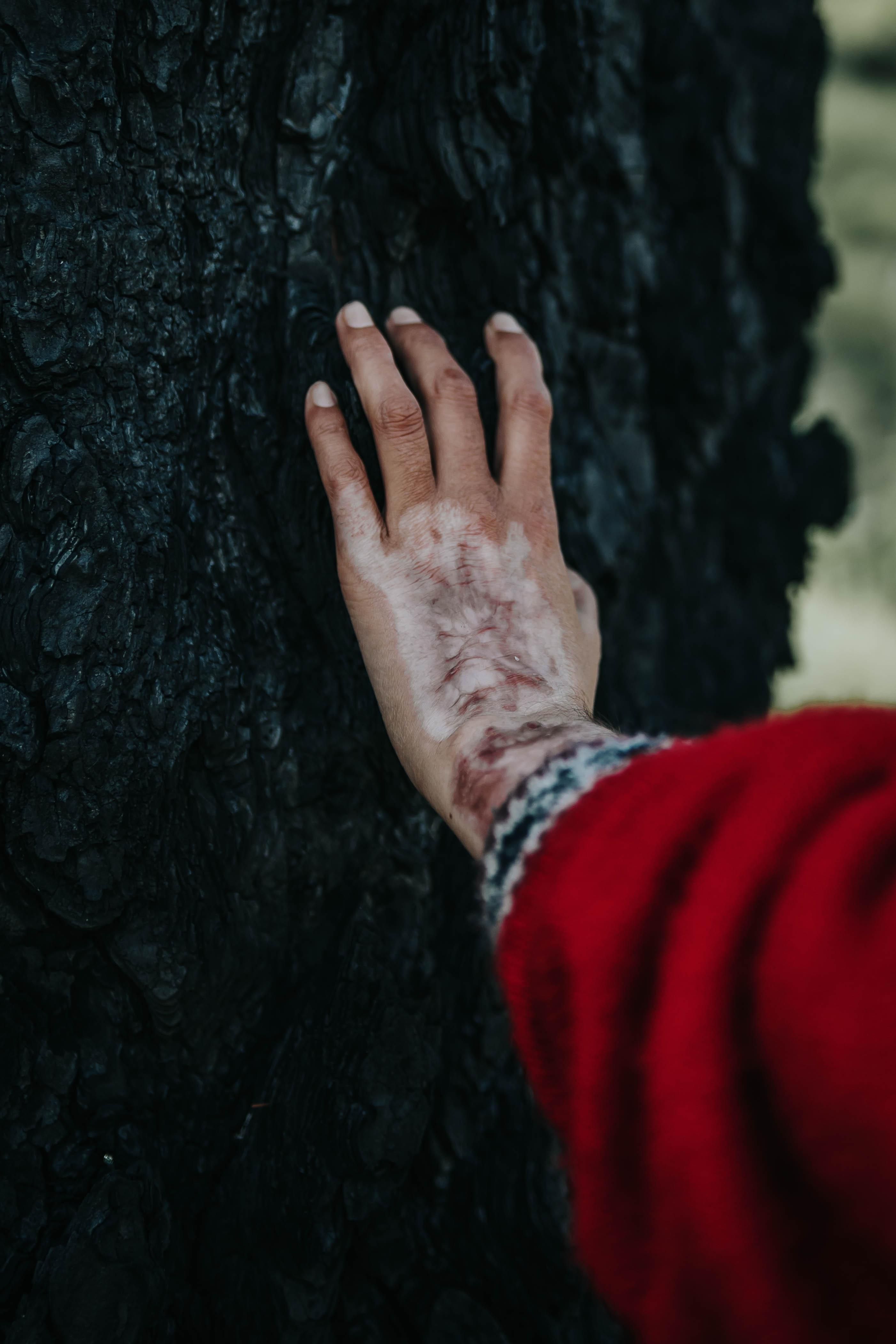 Andrea sufrió quemaduras en varias partes de su cuerpo.