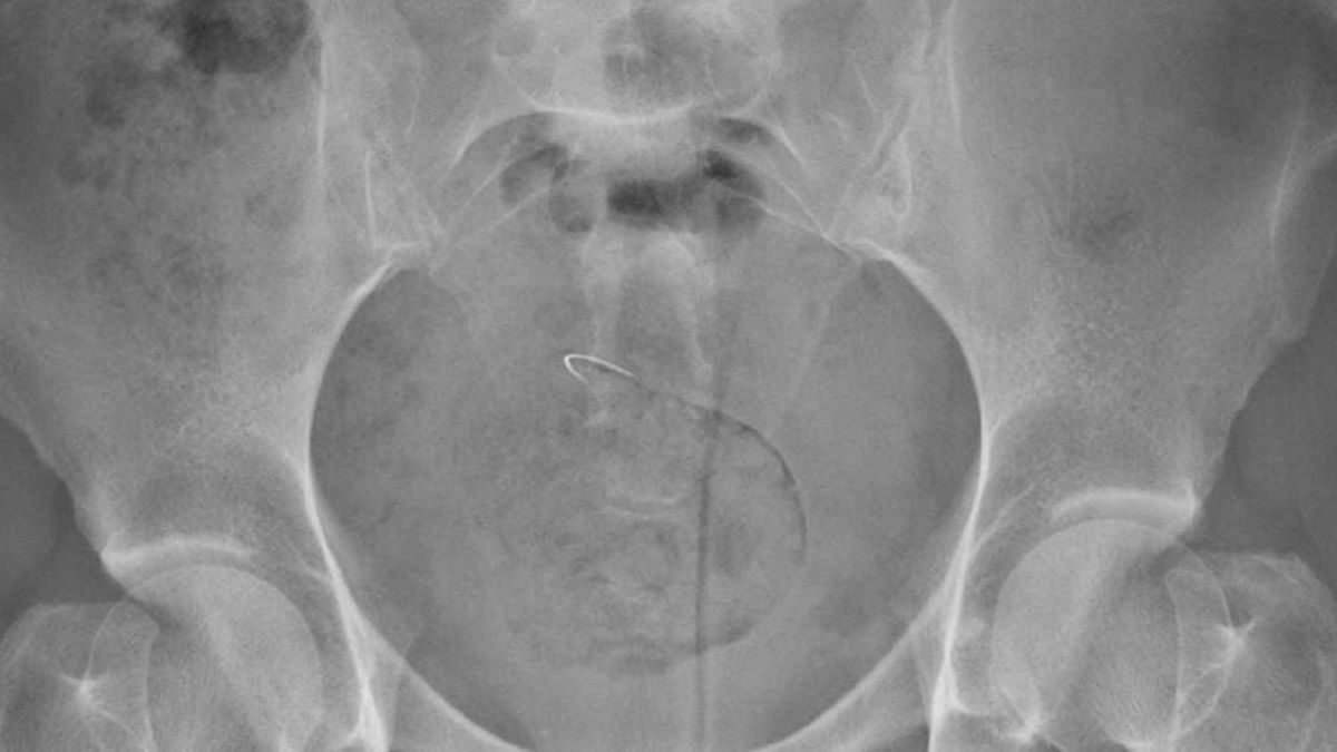 Una mujer estuvo dos meses con una aguja en la pelvis tras ser operada en el Materno de Gran Canaria