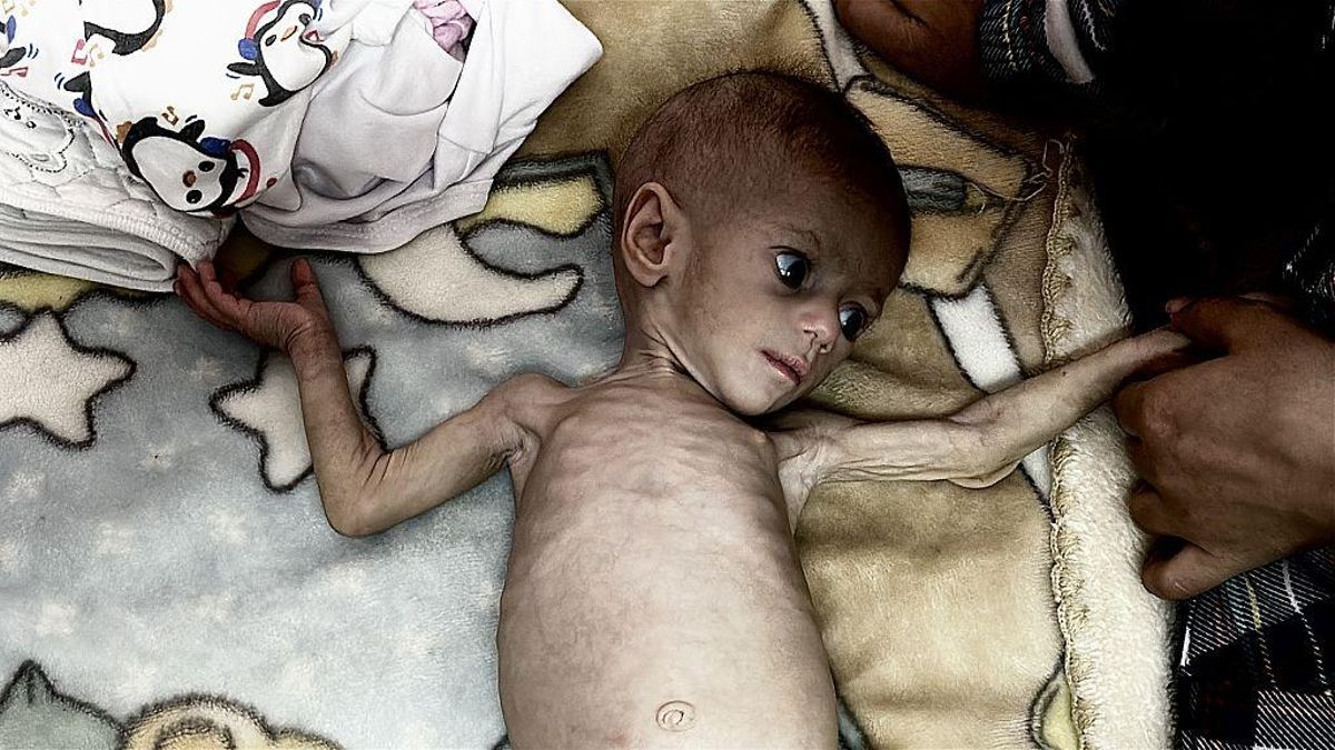 Suwar Ashur, de cinco meses, ingresado en el hospital por desnutrición