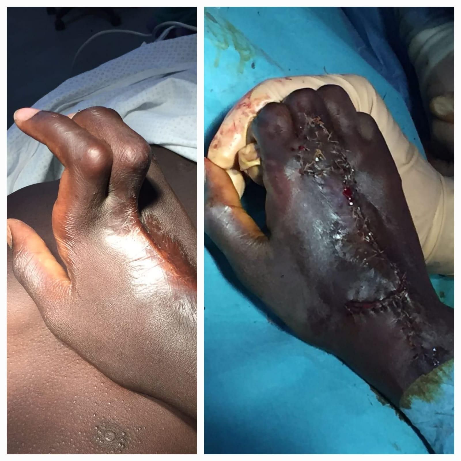 Dits retrets per picadura de serp. Abans i després de l'operació.