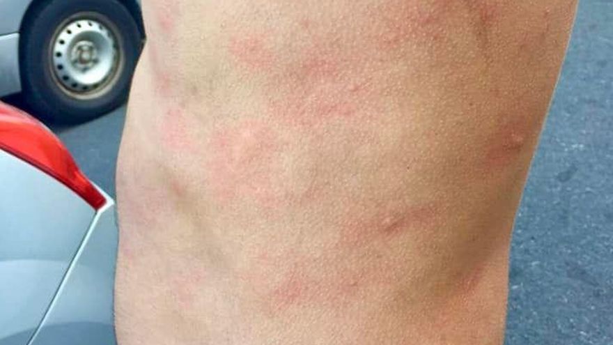 Un surfista muestra las ronchas que le salieron en el cuerpo después de hacer deporte en la costa de Garachico