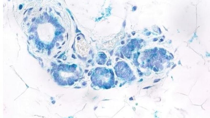 Descubren un mecanismo dual en una proteína iniciadora del cáncer de mama