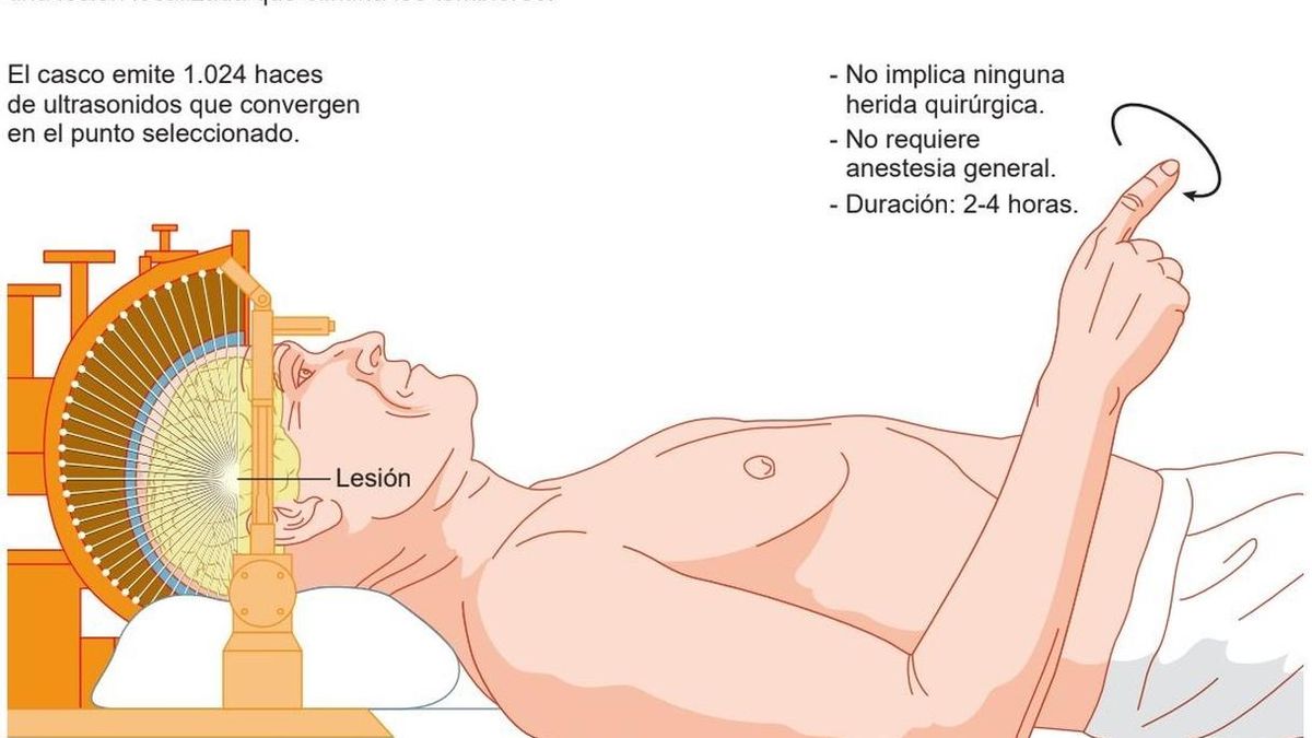 Clínica Universidad de Navarra incorpora ultrasonidos para tratar sin cirugía el temblor del Parkinson