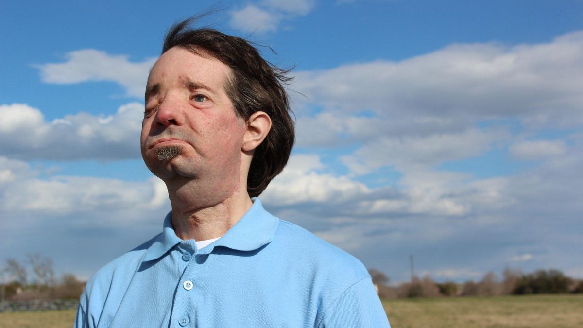 Dallas Wiens, un año después del trasplante de cara