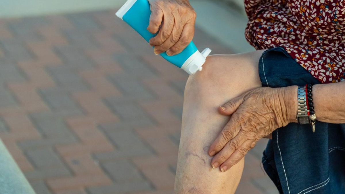 Crema para las varices