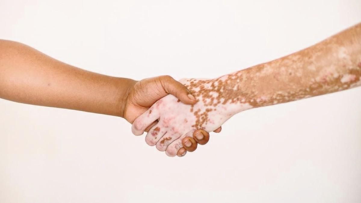 El vitíligo es una forma de albinismo, consideradas ambas dolencias enfermedades raras.