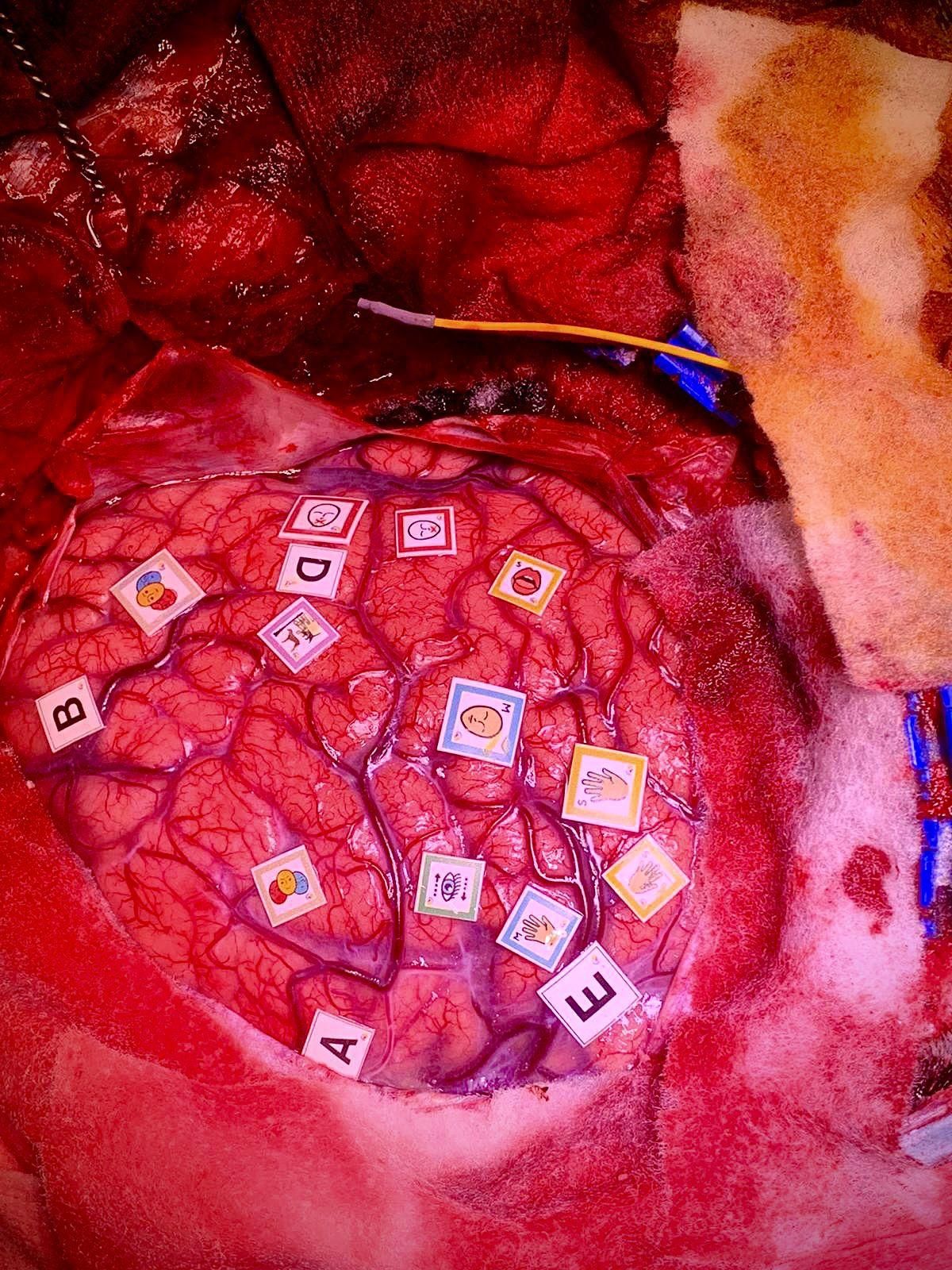 El cerebro de la paciente durante la intervención.