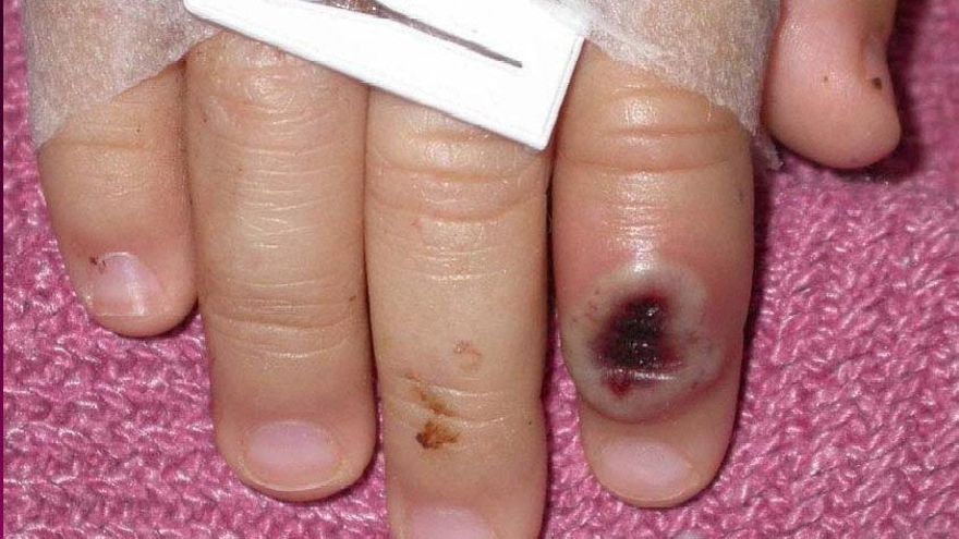 Un estudio sugiere que el brote de viruela del mono que afecta a varios países tiene un origen único