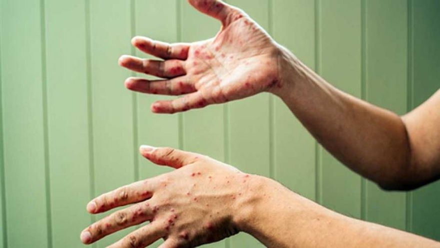 El Ministerio de Salud informó un "posible caso" de sarampión en CABA y emitió alerta epidemiológica