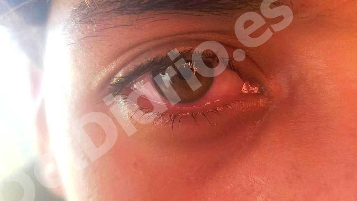 Reda, menor de edad, muestra la irritación del ojo tras ser agredido con gas pimienta.
