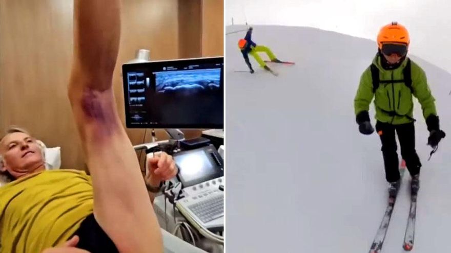 Jesús Calleja muestra la caída que le ha provocado una grave lesión en la pierna: "Metí la pata hasta el fondo"