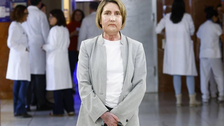 El primer trasplante de cara del mundo con una donante de eutanasia, practicado en España