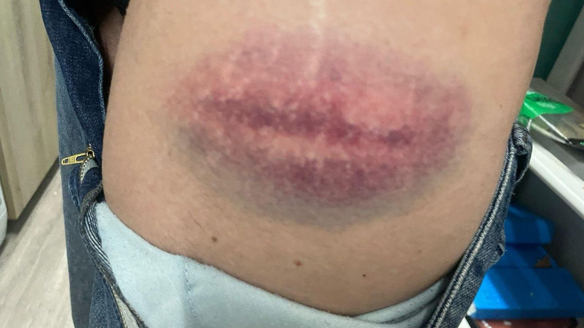 Más heridas mostradas por los manifestantes