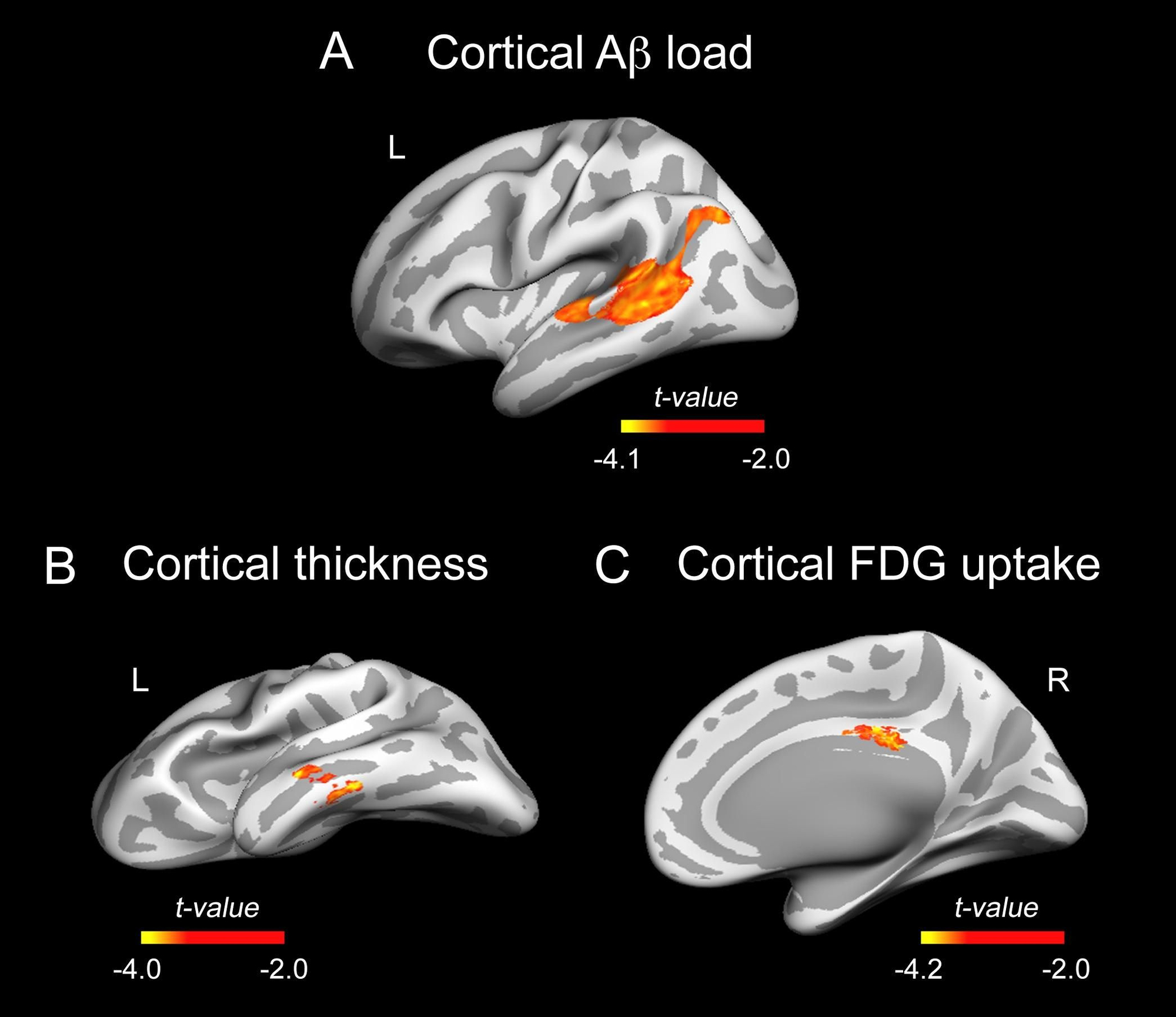 Regiones de la corteza cerebral que muestran una relación significativa con los niveles de lactoferrina en saliva. A. Concentración de beta amiloide medido con PET de amiloide. B. Grosor de la corteza medido con resonancia magnética. C. Consumo metabólico de glucosa medido con PET de glucosa.