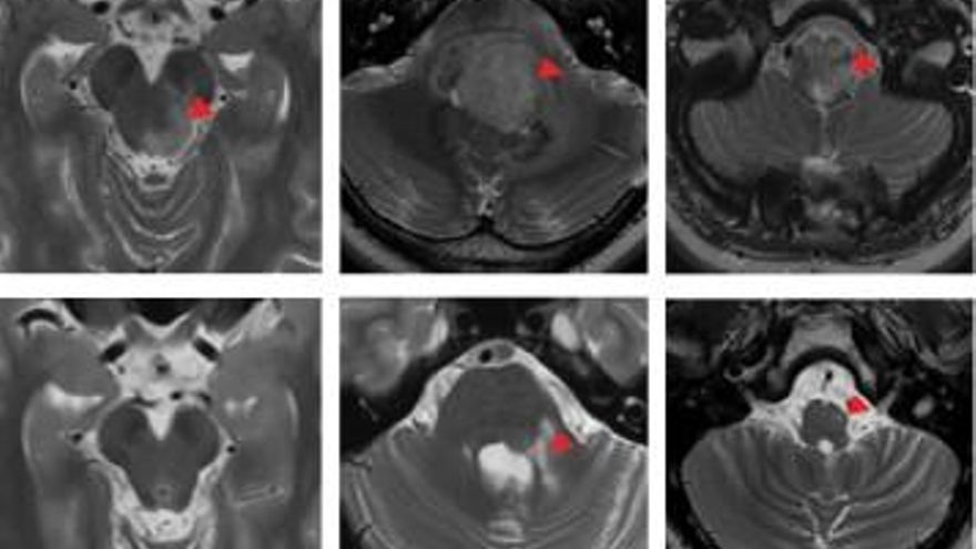 La terapia CAR-T consigue la remisión completa de un tumor cerebral incurable en un paciente de 17 años