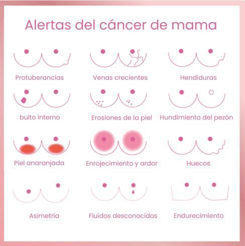 Signos de alerta del cáncer de mama.