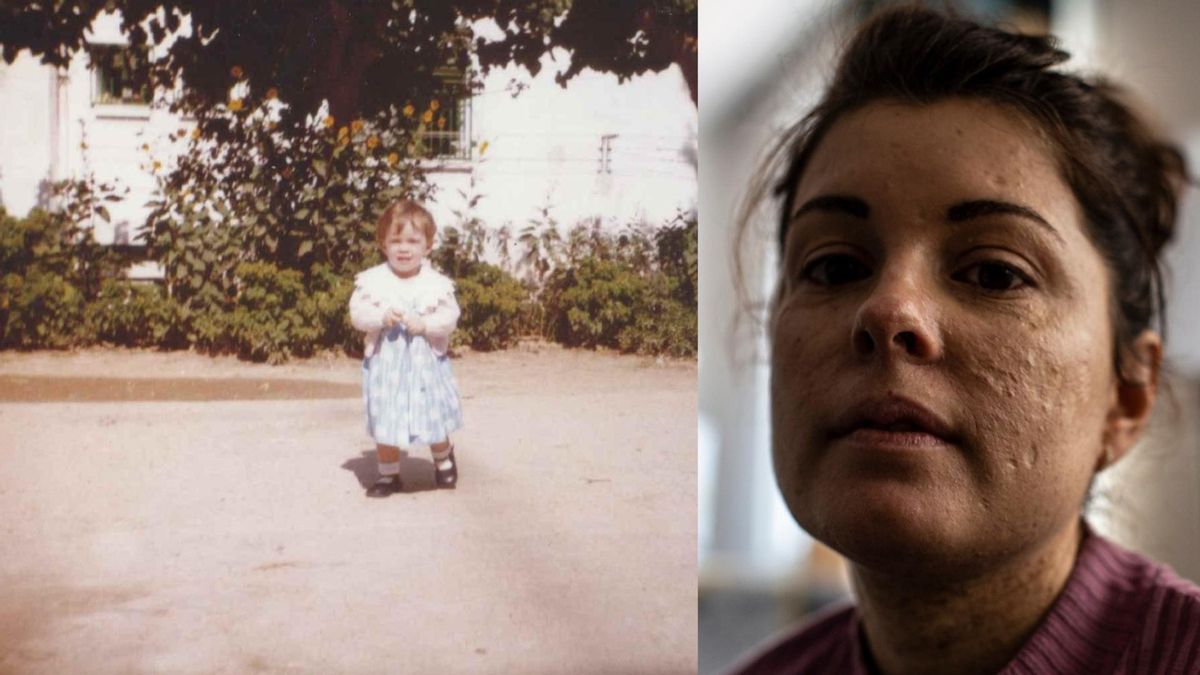 Susana, de 34 años, fue diagnosticada con tres años. En la imagen, una fotografía de archivo de ella de bebé a pleno sol y un retrato actual.